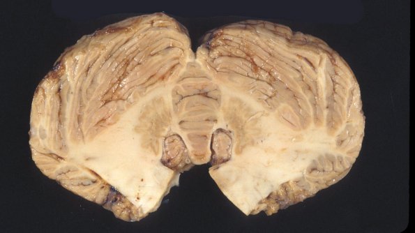 3A4 Hypoglycemic Encephalopathy (Case 3) A3