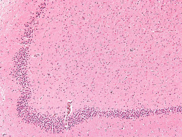 3B2 Hypoglycemia (Case 3) Hippocampus H&E 3B