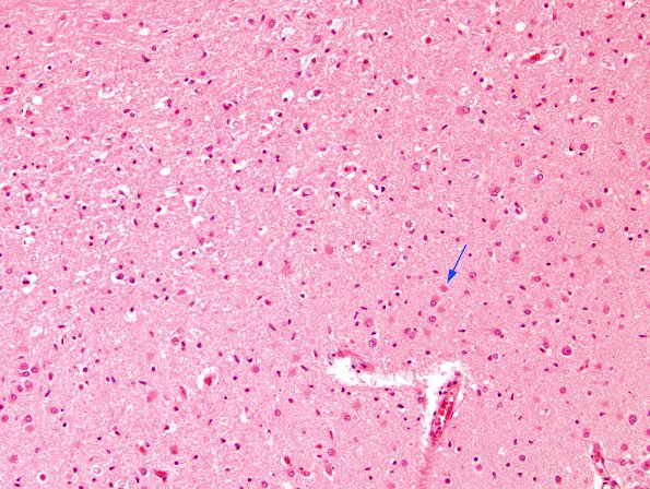 3B3 Hypoglycemia (Case 3) Hippocampus H&E CA4 copy