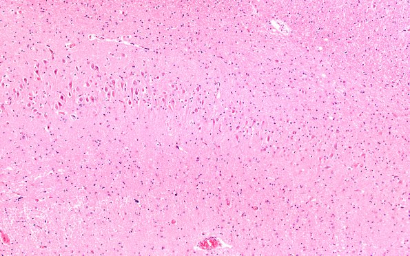 3B4 Hypoglycemia (Case 3) Hippocampus H&E CA2-3