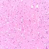 3B5 Hypoglycemia (Case 3) Hippocampus H&E subiculum