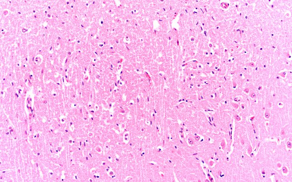 3B5 Hypoglycemia (Case 3) Hippocampus H&E subiculum