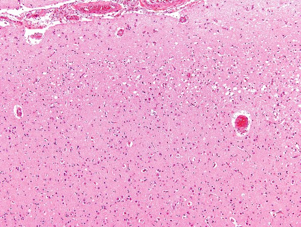 3C2 Hypoglycemia (Case 3) Cerebral Cortex H&E 1