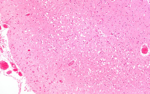 3C3 Hypoglycemia (Case 3) N5 H&E 10X