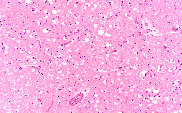 3C4 Hypoglycemia (Case 3) N5 H&E 20X