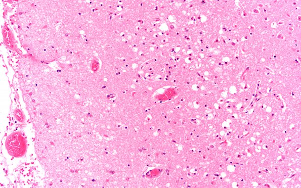 3C5 Hypoglycemia (Case 3) N5 H&E 40X