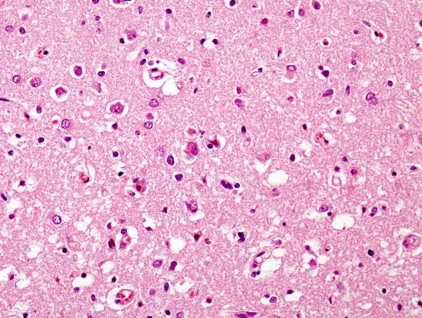 3C6 Hypoglycemia (Case 3) Cerebral Cortex H&E 2