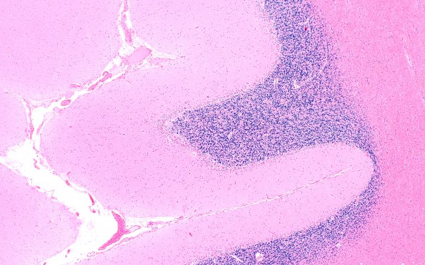 3D1 Hypoglycemia (Case 3) Cerebellum H&E 4X