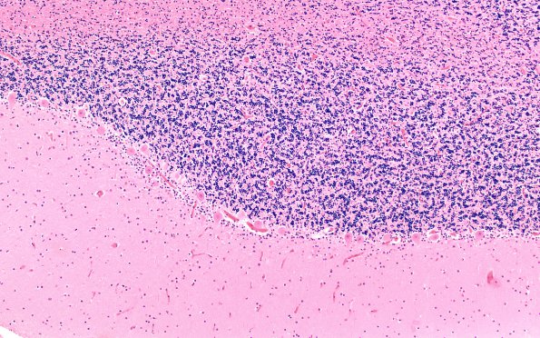 3D2 Hypoglycemia (Case 3) Cerebellum H&E 4