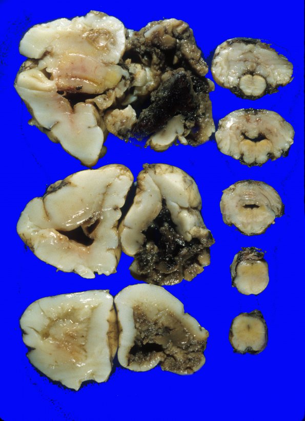 10 Kernicterus (Case 10) 1