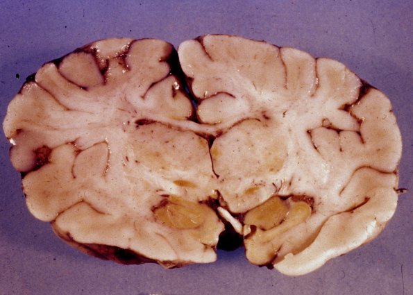 12A1 Kernicterus (Case 12) gross 1