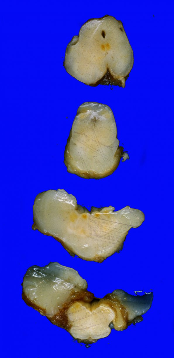 13A1 Kernicterus (Case 13) A1