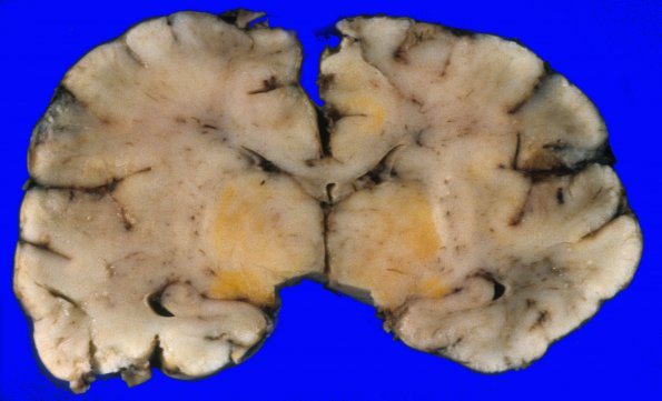 15A1 Kernicterus (Case 15) 1