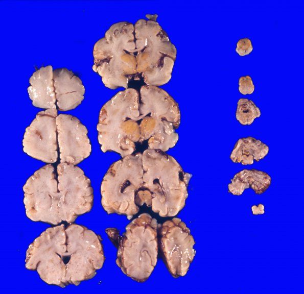 1A1 Kernicterus (Case 1) 2