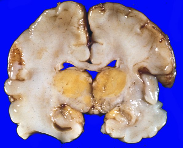 1A2 Kernicterus (Case 1) 3