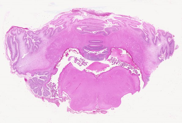 3B1 Kernicterus (Case 3) ION neuron loss & Luschka foramena