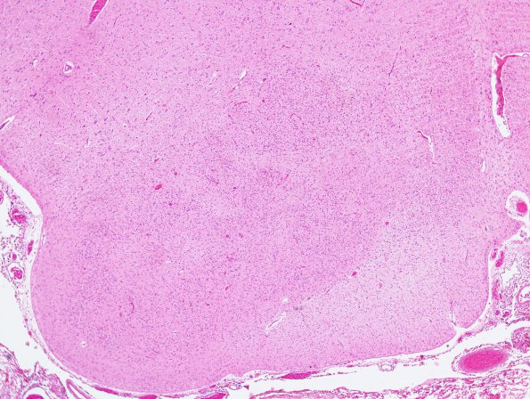 3B2 Kernicterus (Case 3) ION neuron loss & Luschka foramena H&E 3