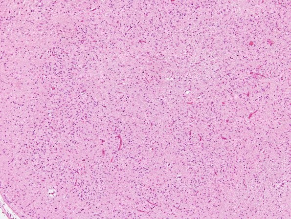 3B3 Kernicterus (Case 3) ION neuron loss & Luschka foramena H&E 2