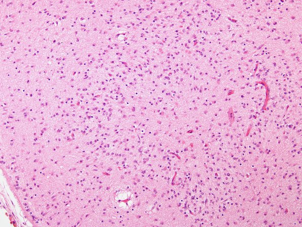 3B4 Kernicterus (Case 3) ION neuron loss & Luschka foramena H&E 1