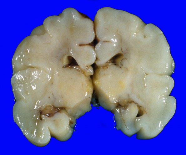 4A3 Kernicterus (Case 4) A5