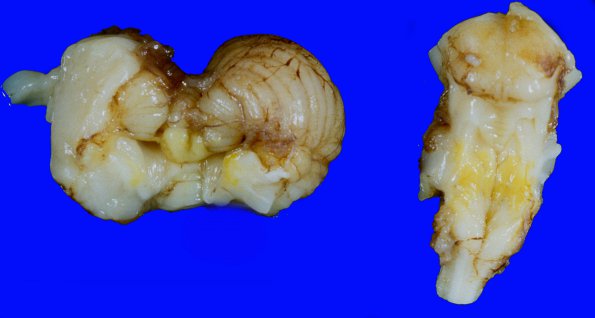 4A4 Kernicterus (Case 4) A7