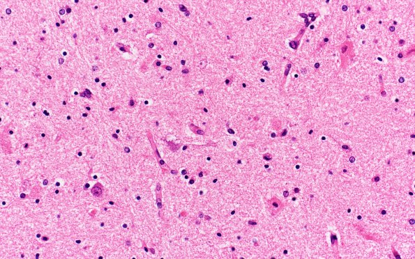 4B Kernicterus (Case 4) N2 H&E