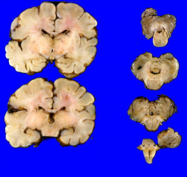 5A1 Kernicterus (Case 5) A2