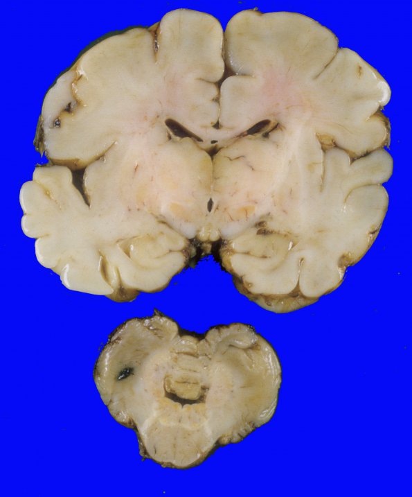 5A2 Kernicterus (Case 5) A1