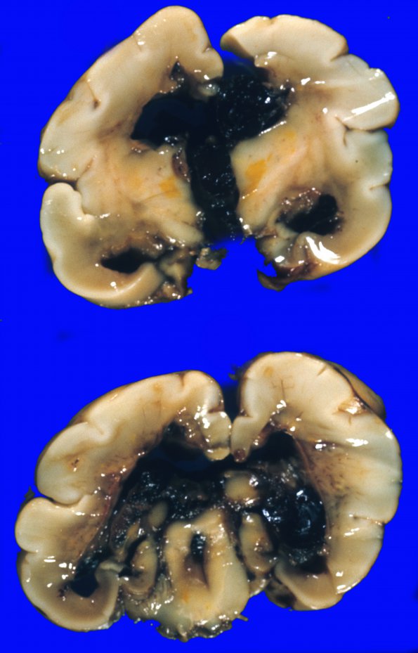 6A1 Kernicterus (Case 6) 1