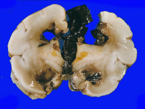 6A2 Kernicterus (Case 6) 2