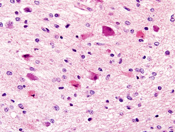 7A2 Kernicterus (Case 7) ION H&E 11.jpg