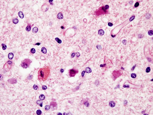 7A4 Kernicterus (Case 7) ION H&E 13.jpg