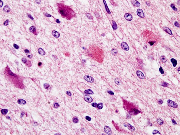 7A5 Kernicterus (Case 7) ION H&E 5.jpg