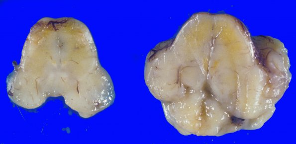 8A3 Kernicterus (Case 8) 1