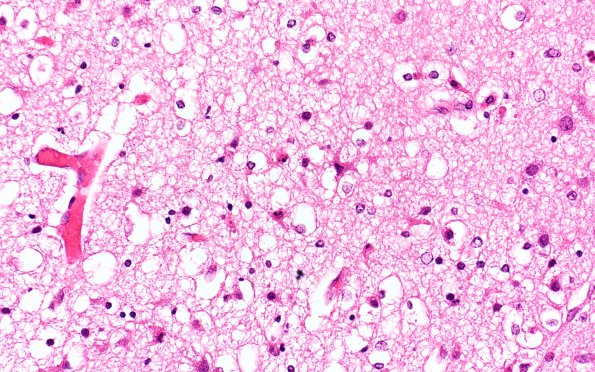 9B2 Kernicterus (Case 9) N13 H&E 40X  with AlzII