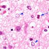 9B3 Kernicterus (Case 9) N13 H&E 100X  with AlzII 2A