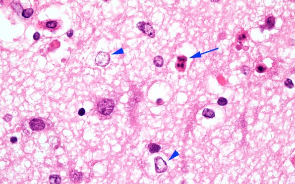 9B3 Kernicterus (Case 9) N13 H&E 100X  with AlzII 2A