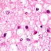 9B4 Kernicterus (Case 9) N13 H&E 100X  with AlzII