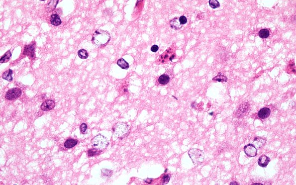 9B5 Kernicterus (Case 9) N13 H&E 100X  with AlzII 3