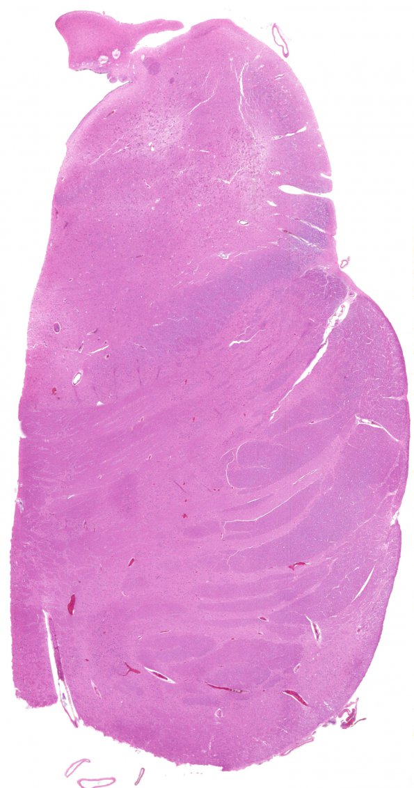 1C1 Leigh Dz (Case 1) H&E whole mount N7B