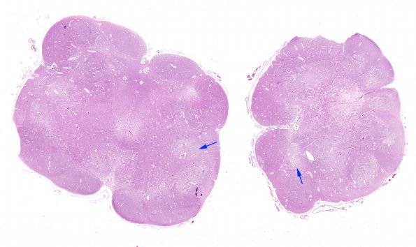 2E1 Leigh Dz (Case 2) Medulla H&E whole mount copy