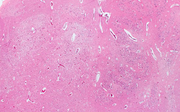 2E2 Leigh Dz & hypoxia ischemia (Case 2) Medulla 2X