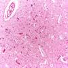 2E3 Leigh Dz & hypoxia ischemia (Case 2) Medulla 10X