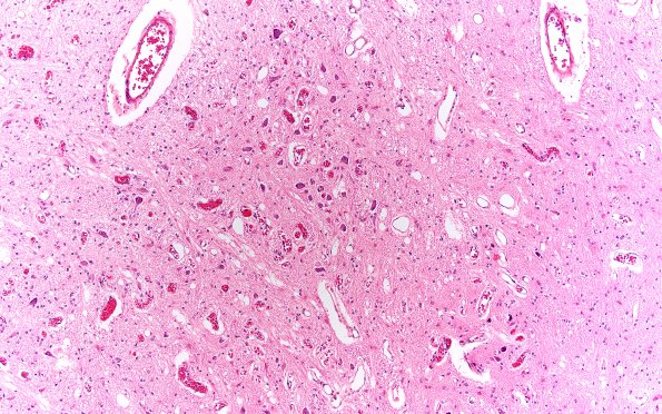 2E3 Leigh Dz & hypoxia ischemia (Case 2) Medulla 10X