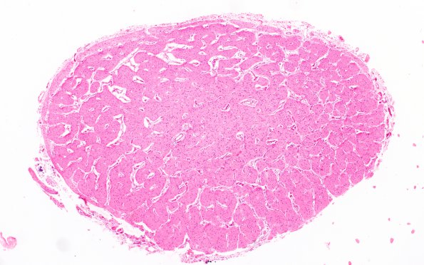 2F1 Leigh Dz & hypoxia ischemia (Case 2) O optic nerve 4X A