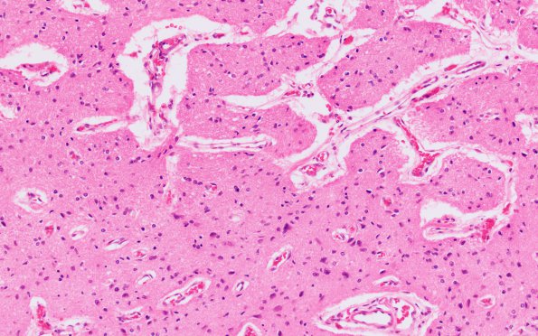 2F2 Leigh Dz & hypoxia ischemia (Case 2) Optic nerve 20X