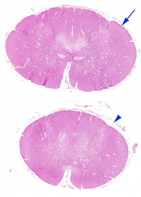 2G1 Leigh Dz (Case 2) L spinal cord H&E whole mount copy