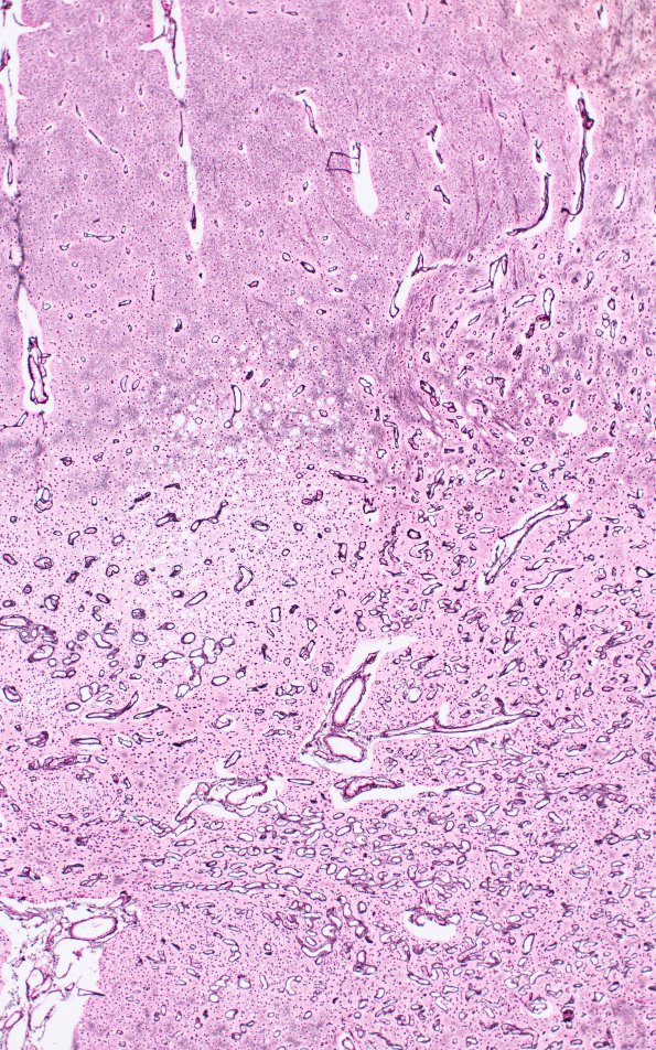 2G10 Leigh Dz (Case 2) L spinal cord Retic 2