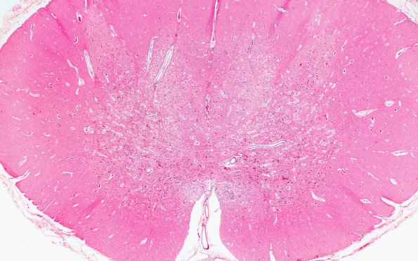 2G2 Leigh Dz (Case 2) L spinal cord H&E 2X