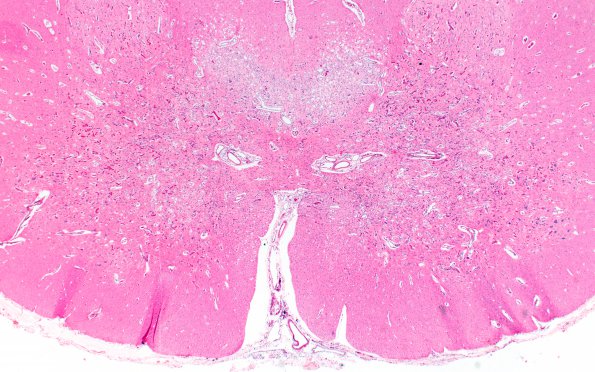 2G4 Leigh Dz (Case 2 L spinal cord H&E 3